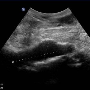 Anévrisme aortique sous rénal sans thrombus 38