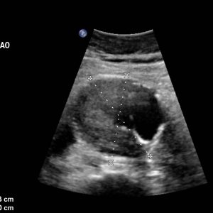 Anévrisme aortique sous rénal sans thrombus 37
