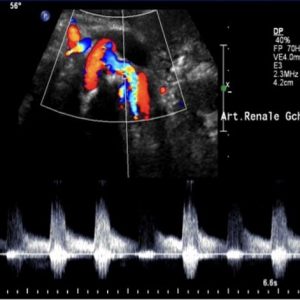 Doppler arétriel rénal 64