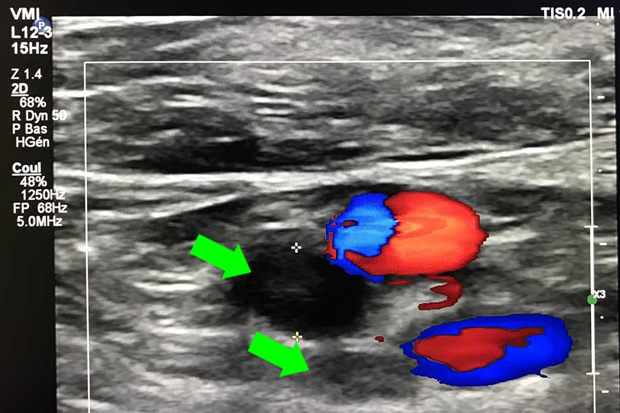 Echo doppler veineux