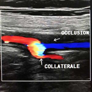 Occlusion de la fémorale superficielle 58