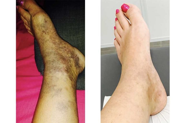 Sclérose des varices à la mousse à Marseille 10 et 15