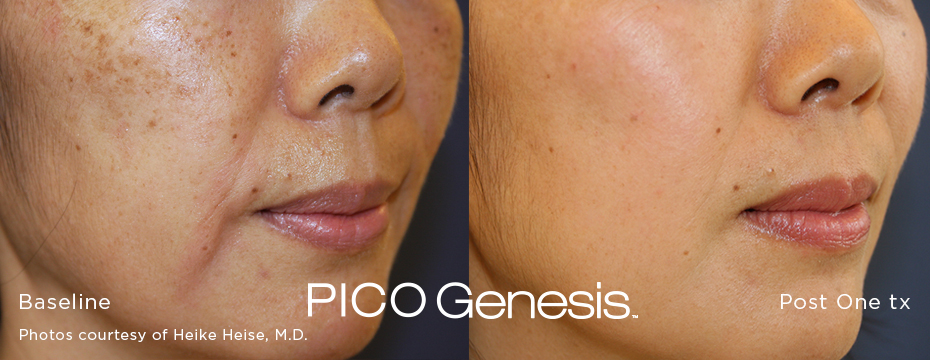 enlighten_pico-genesis_2