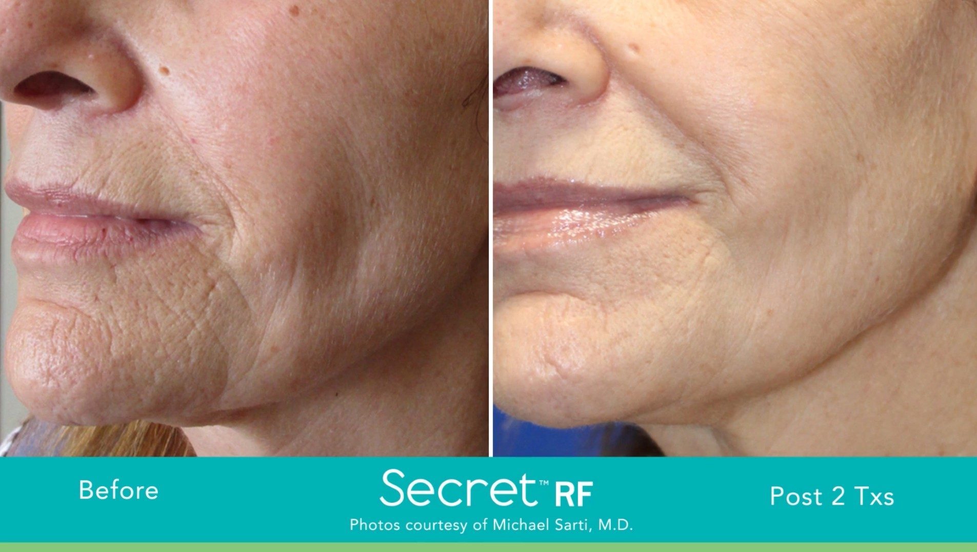 Deux photos de visage avant et après Microneedling