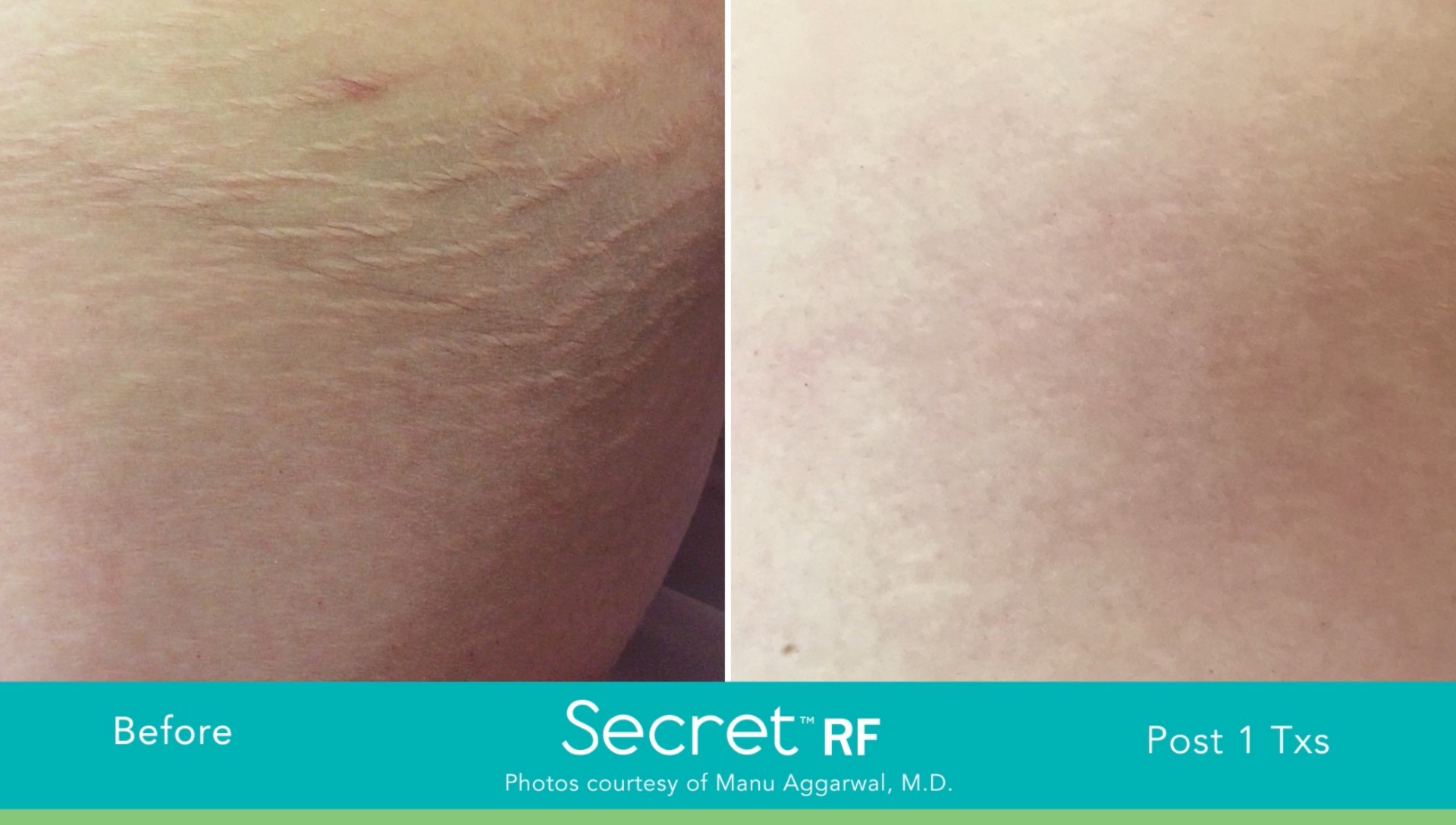 Deux photos avant et après Microneedling