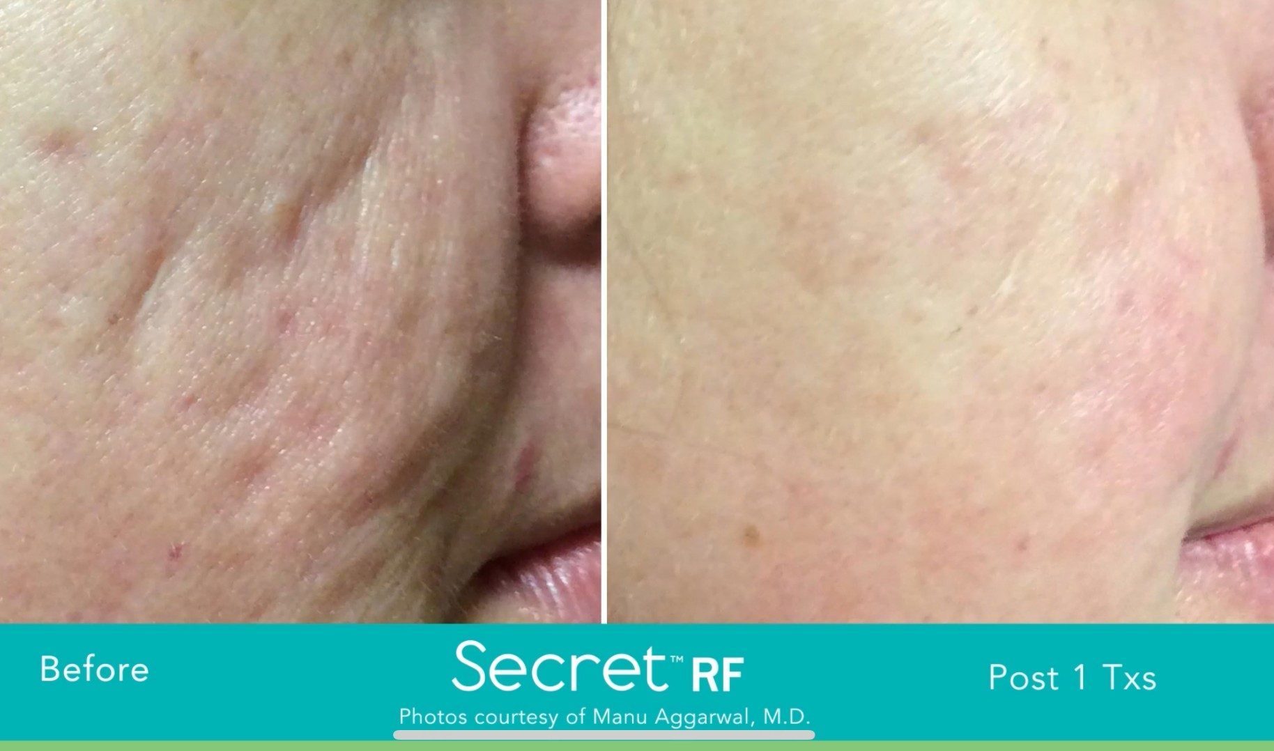 Photos avant et après traitement Microneedling contre la vieillesse